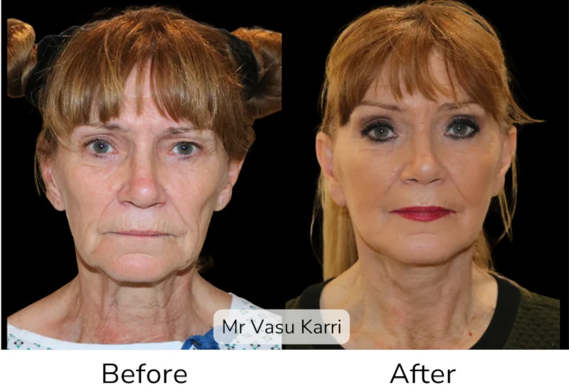 Facelift Patient 14 View 1